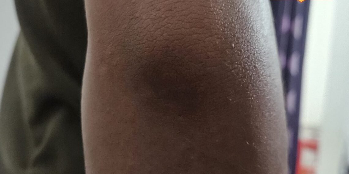 कोहनी के कालेपन से हैं परेशान? आजमाएं रसोई में रखा ये कमाल का नुस्खा, कुछ ही दिनों में दिखेगा असर